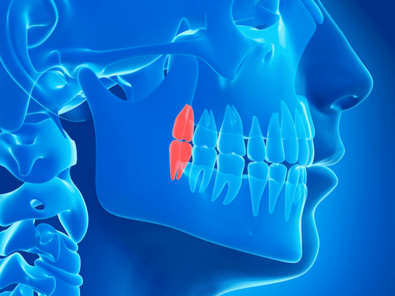Impacted Wisdom Teeth: Everything You Need to Know