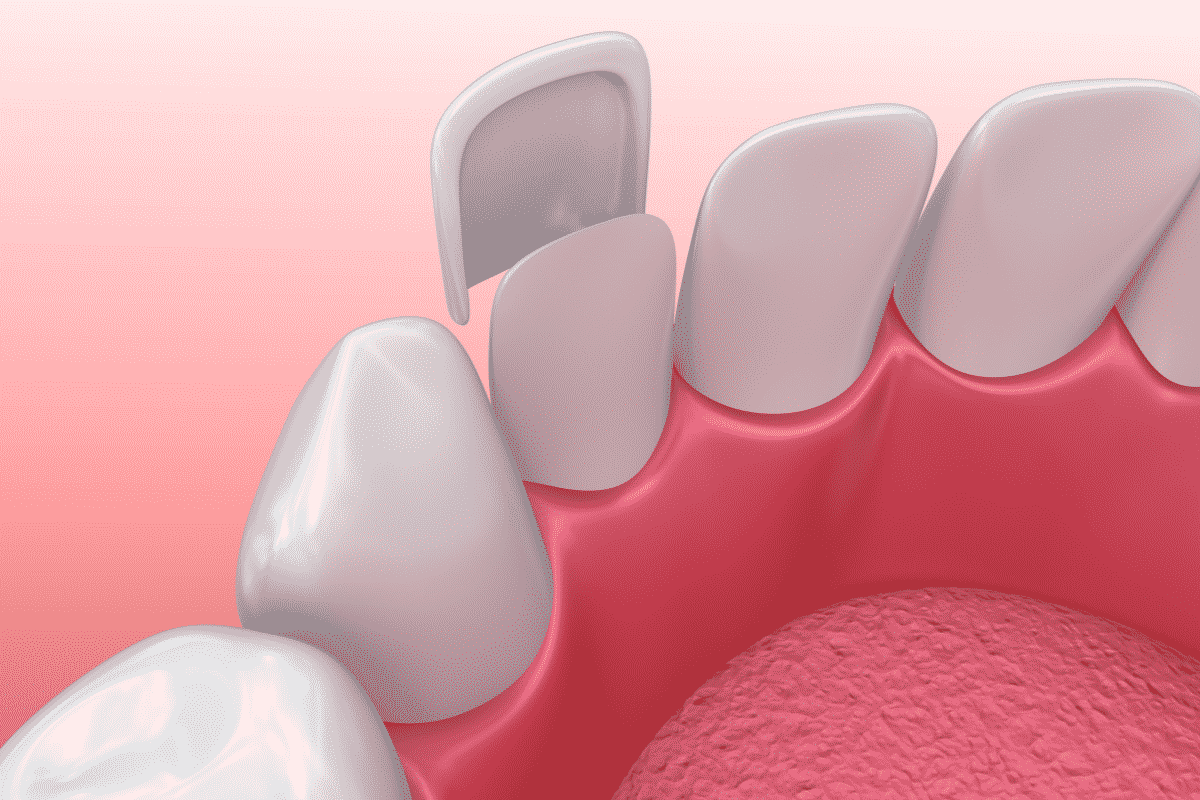 Family Dental Care: Veneers vs Lumineers