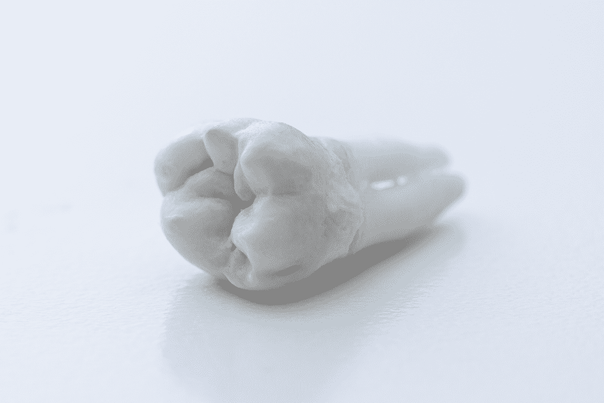 What are Wisdom Tooth Extractions?