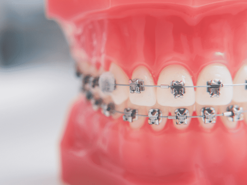Dental Braces: Getting to Know the Different Types