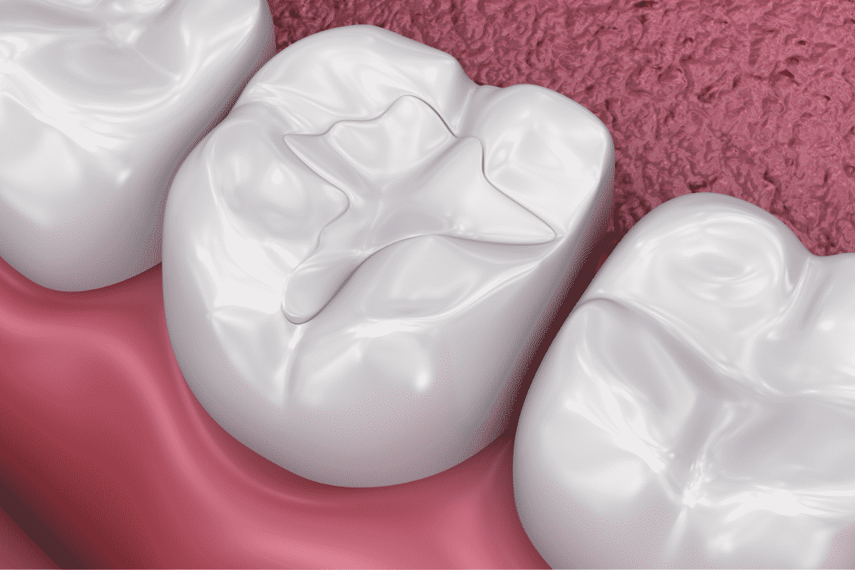 Walnut Grove Cosmetic Dentistry: Composite Fillings