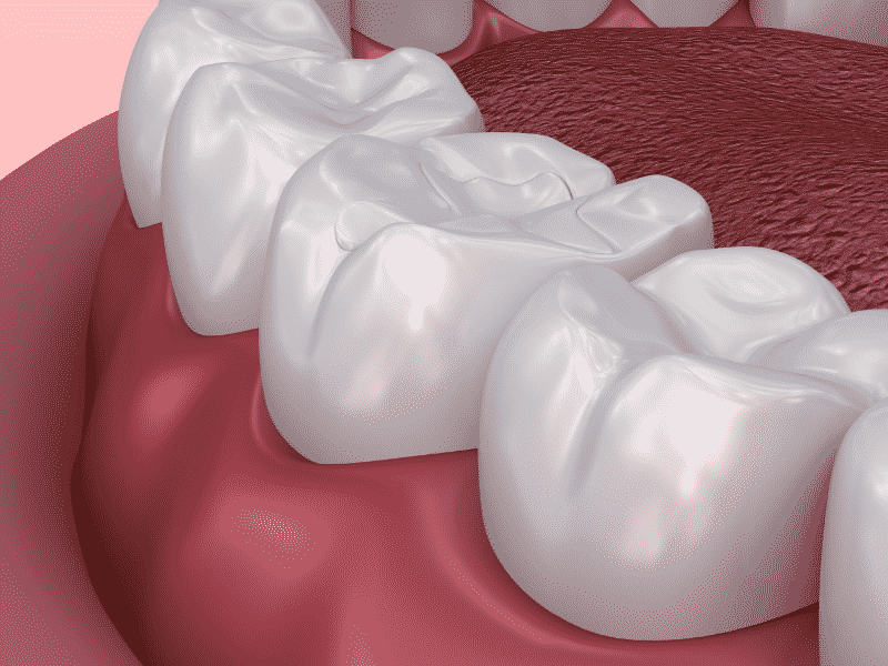 What is a Dental Sealant?