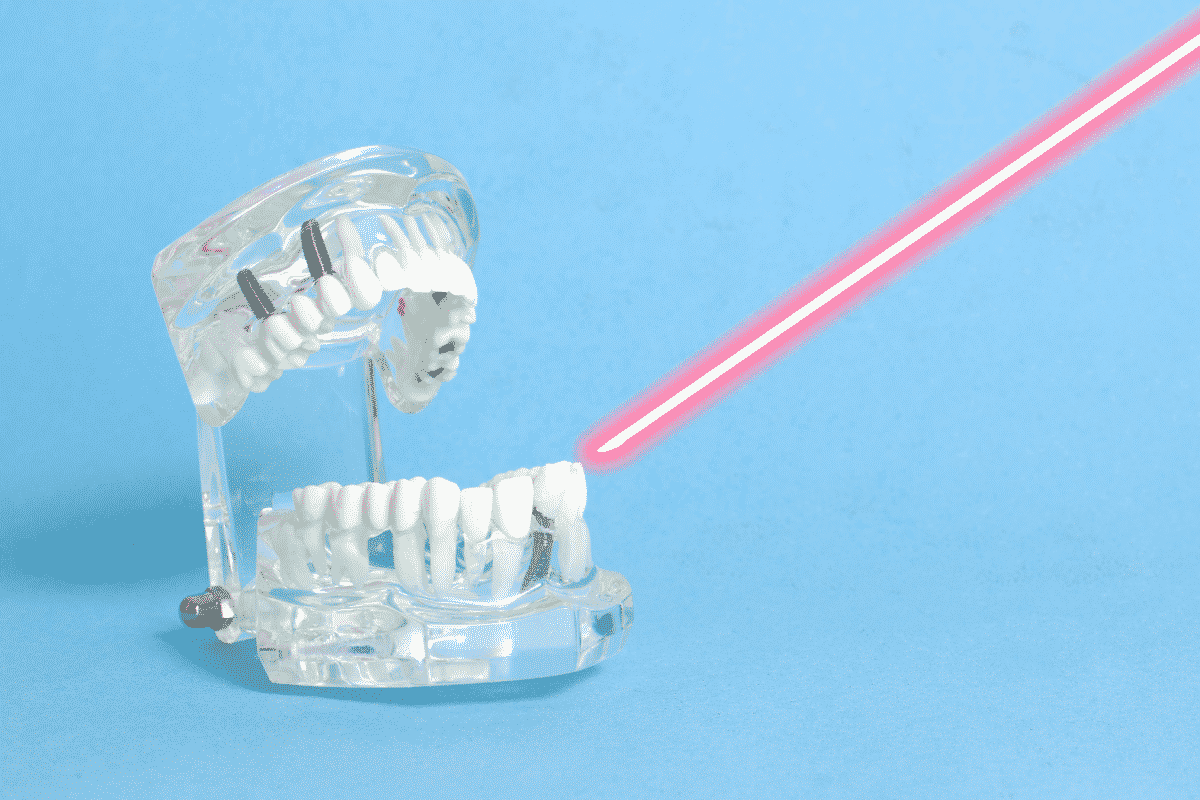 Laser Dentistry for Cavities in Langley