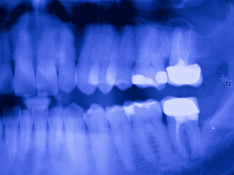 Composite Fillings JVR dental