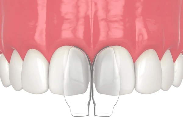 dental bonding in walnut grove, bc