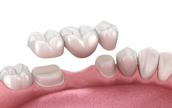 dental bridges in walnut grove, bc