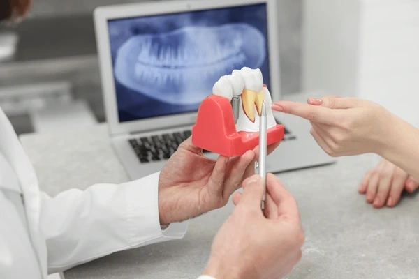dental implants in walnut grove, bc