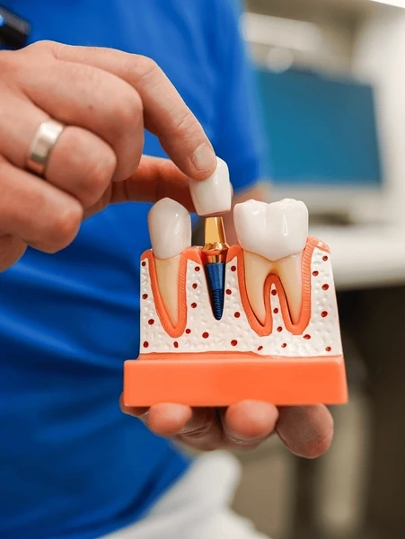 dental implants near you