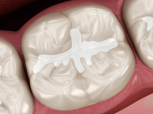 dental sealants in walnut grove, bc