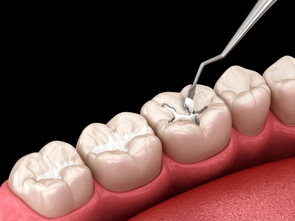 dental sealants near you