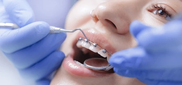 orthodontics in walnut grove, bc