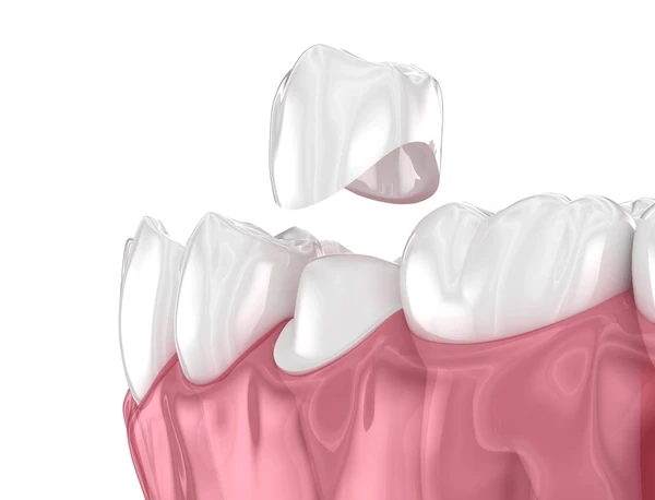 restore a damaged tooth in one visit