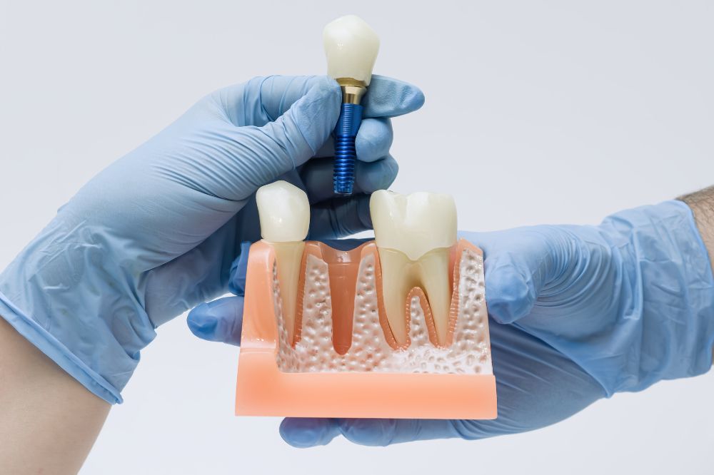 dental implants and bone health